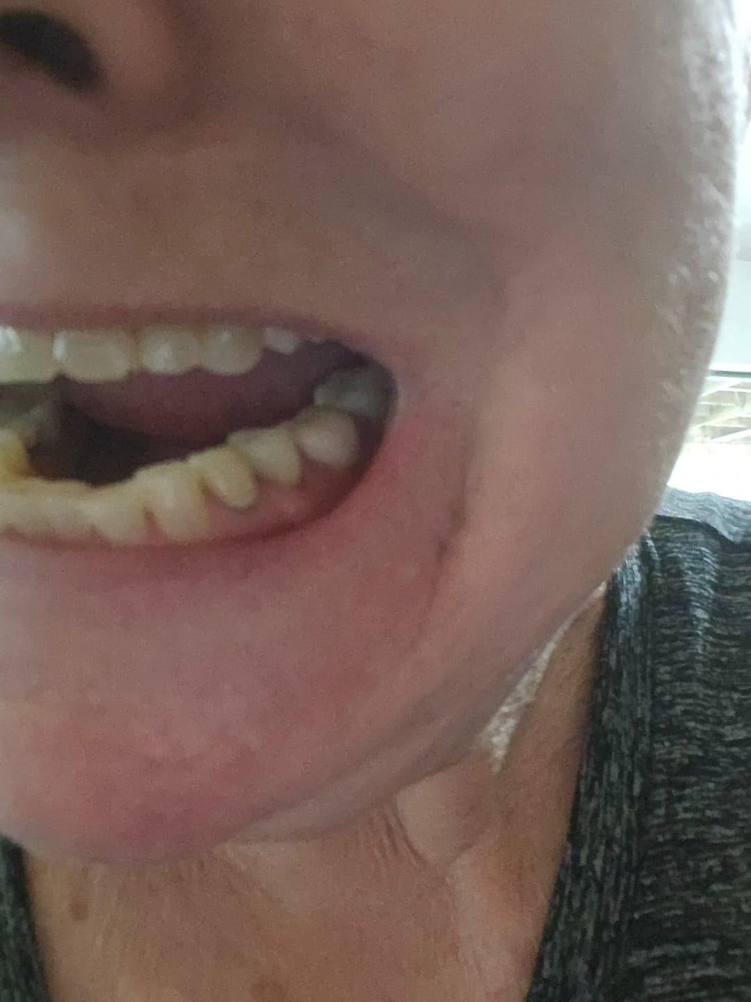 Customer photo review of Unilateral Partial Denture