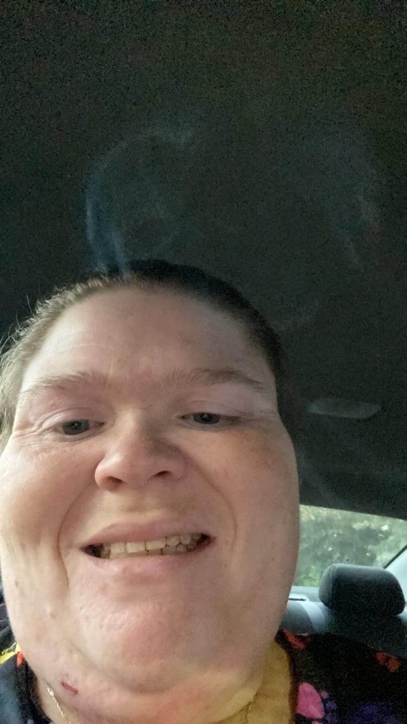 Customer photo review of Acrylic Partial Flipper Denture