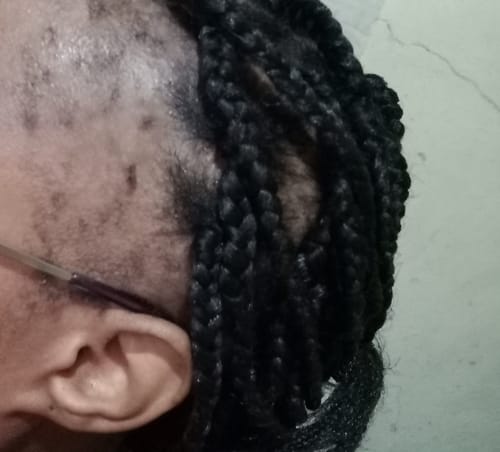 Customer photo review of Minoxidil REGULAR (2%) strength FOAM, 1x60ml pack