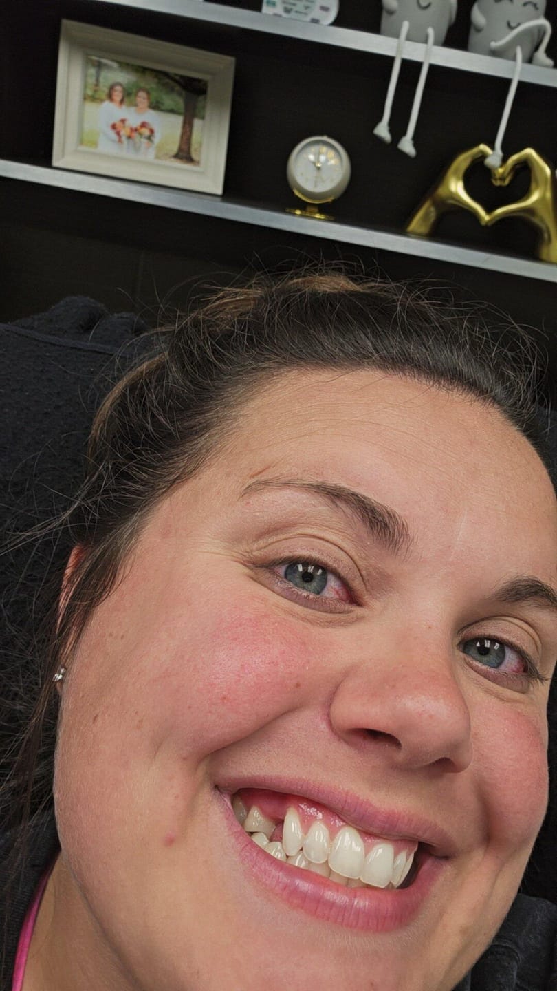 Customer photo review of Unilateral Partial Denture