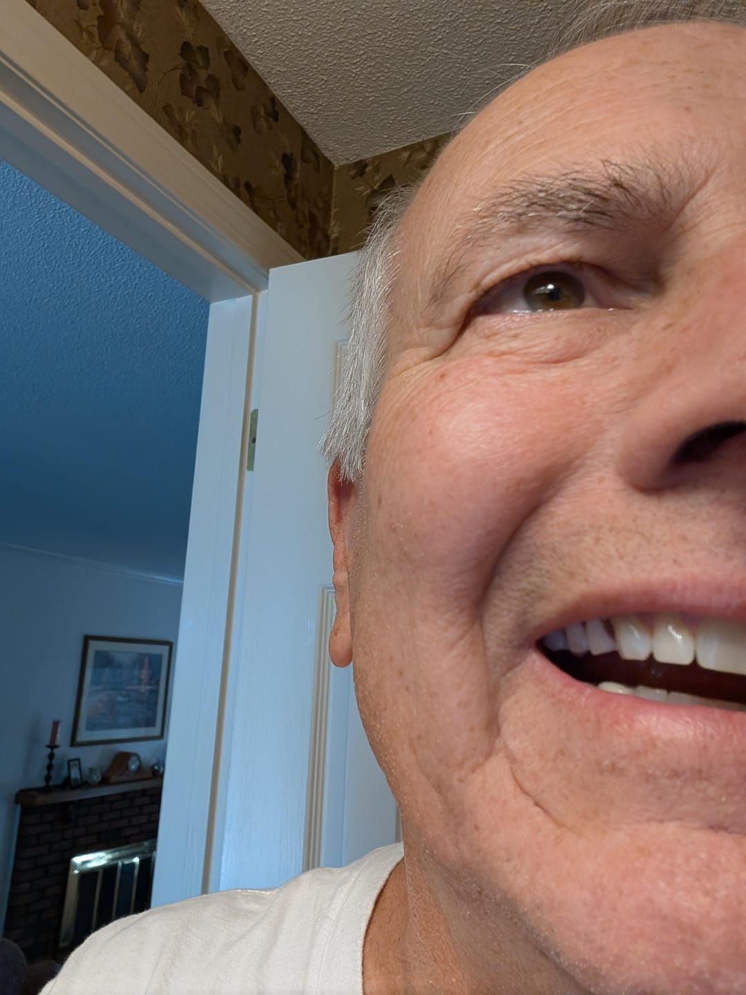 Customer photo review of Unilateral Partial Denture