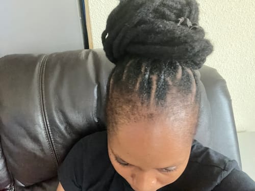 Customer photo review of Minoxidil High Strength (5%) FOAM, 3x60ml pack