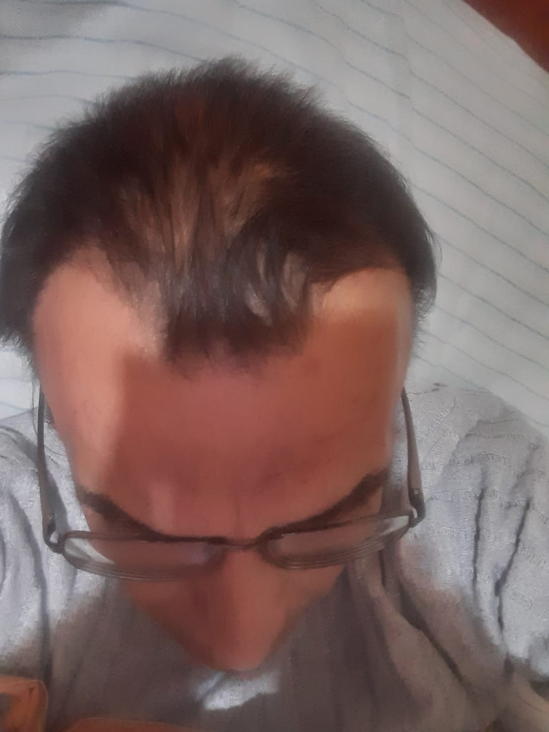 Customer photo review of Pack Anticaída de Cabello para 1 Mes