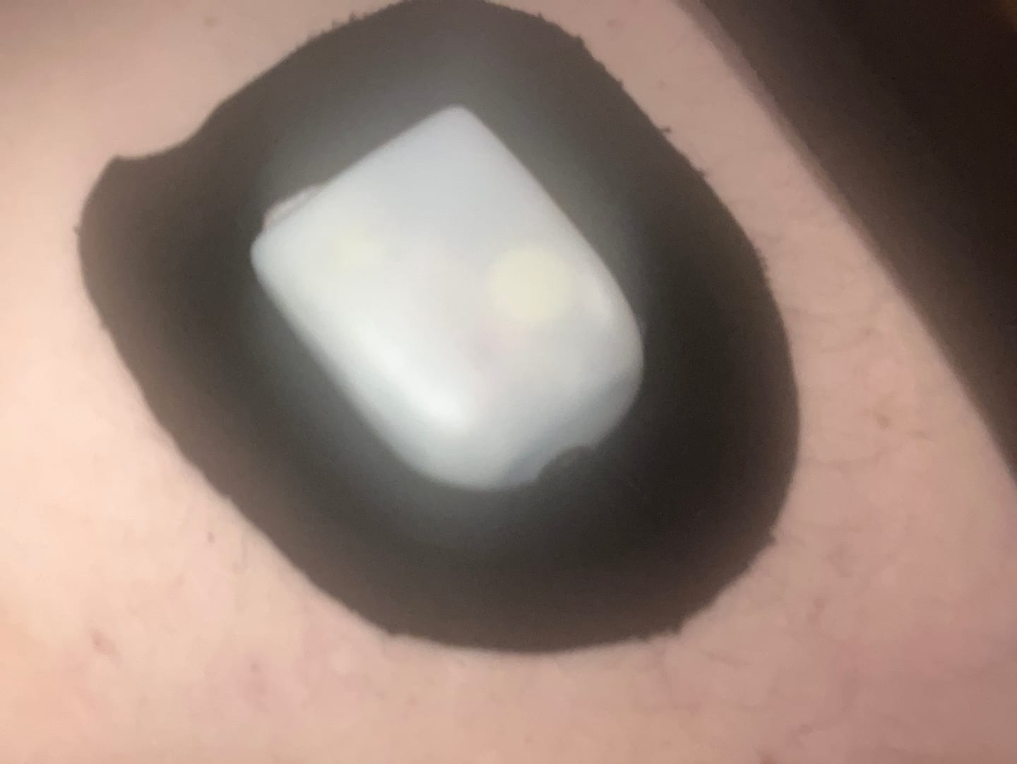 Customer photo review of Skin Grip Original - Omnipod Adhesive Patches