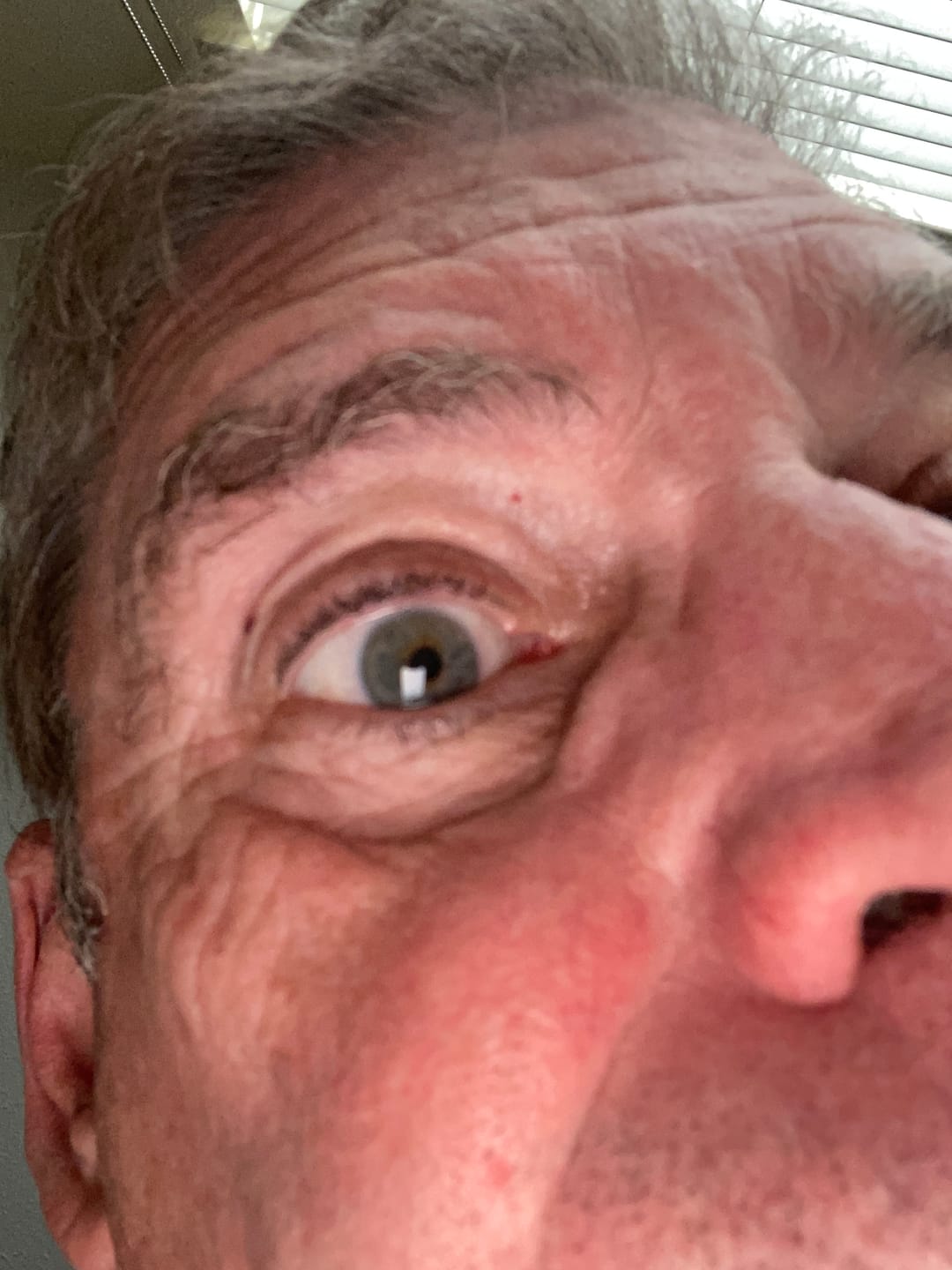 Customer photo review of OPTASE® HYLO Relief™ Dry Eye Drops