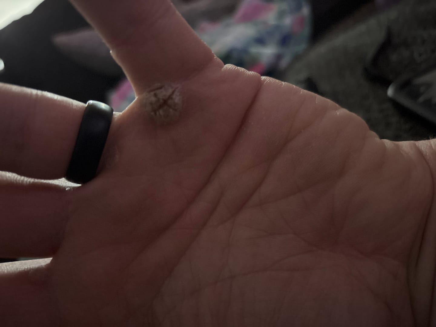 Customer photo review of The Wartabater | Electronic Wart Remover | Safe, Easy, & Effective