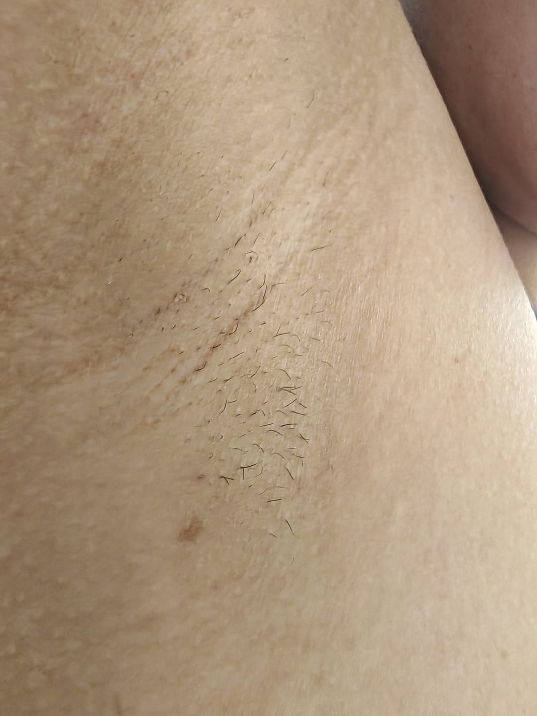 Customer photo review of ILUUMI IPL *BLACK FRIDAY SALE*