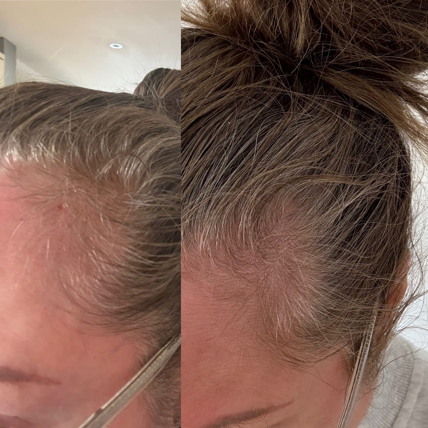 Customer photo review of LED Red Light Therapy Hair Growth Cap