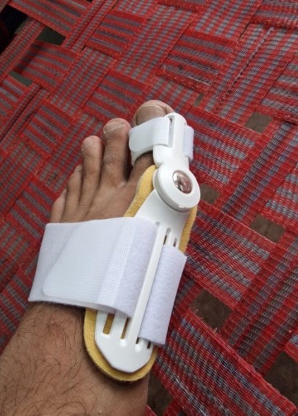 Customer photo review of Pain Relief Bunion Toe Corrector - (IMPORTED)