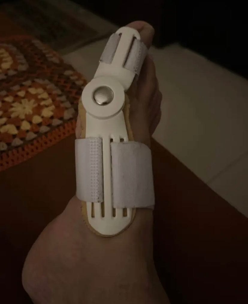 Customer photo review of Pain Relief Bunion Toe Corrector - (IMPORTED)