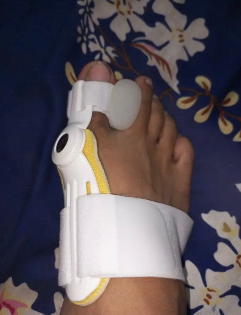 Customer photo review of Pain Relief Bunion Toe Corrector - (IMPORTED)