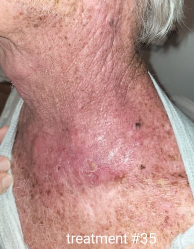 Customer photo review of Radiation Relief Cream – Unscented Burn Cream for Radiation Therapy