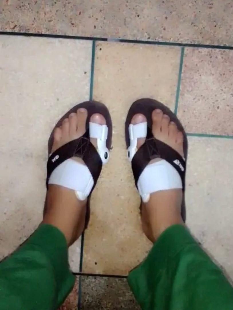 Customer photo review of Pain Relief Bunion Toe Corrector - (IMPORTED)