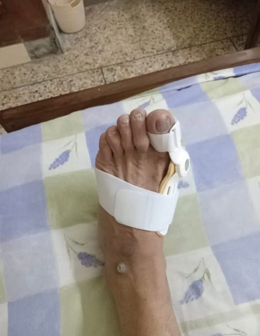 Customer photo review of Pain Relief Bunion Toe Corrector - (IMPORTED)