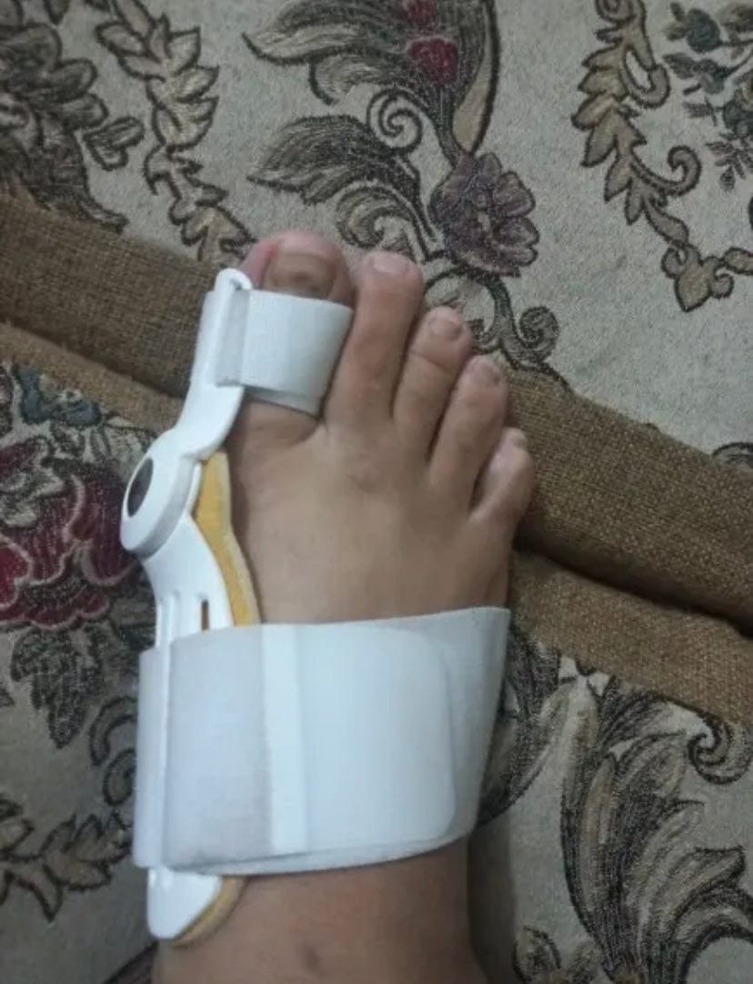 Customer photo review of Pain Relief Bunion Toe Corrector - (IMPORTED)