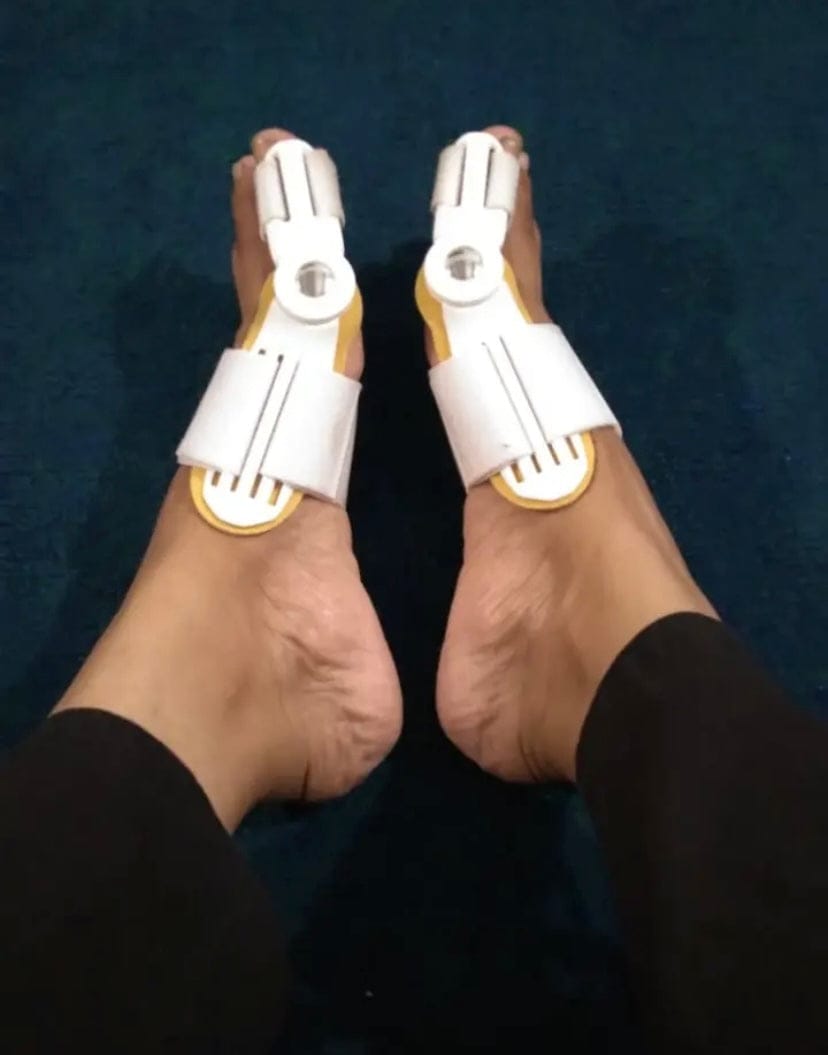 Customer photo review of Pain Relief Bunion Toe Corrector - (IMPORTED)