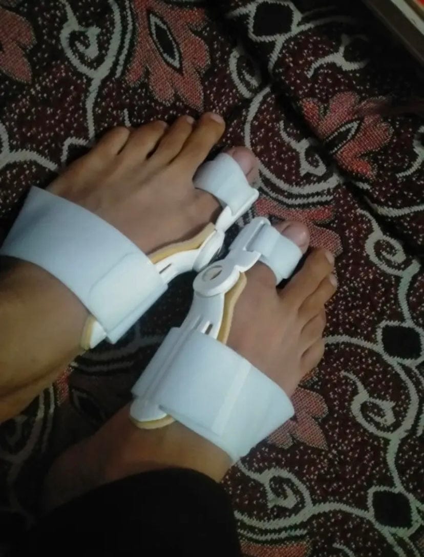 Customer photo review of Pain Relief Bunion Toe Corrector - (IMPORTED)