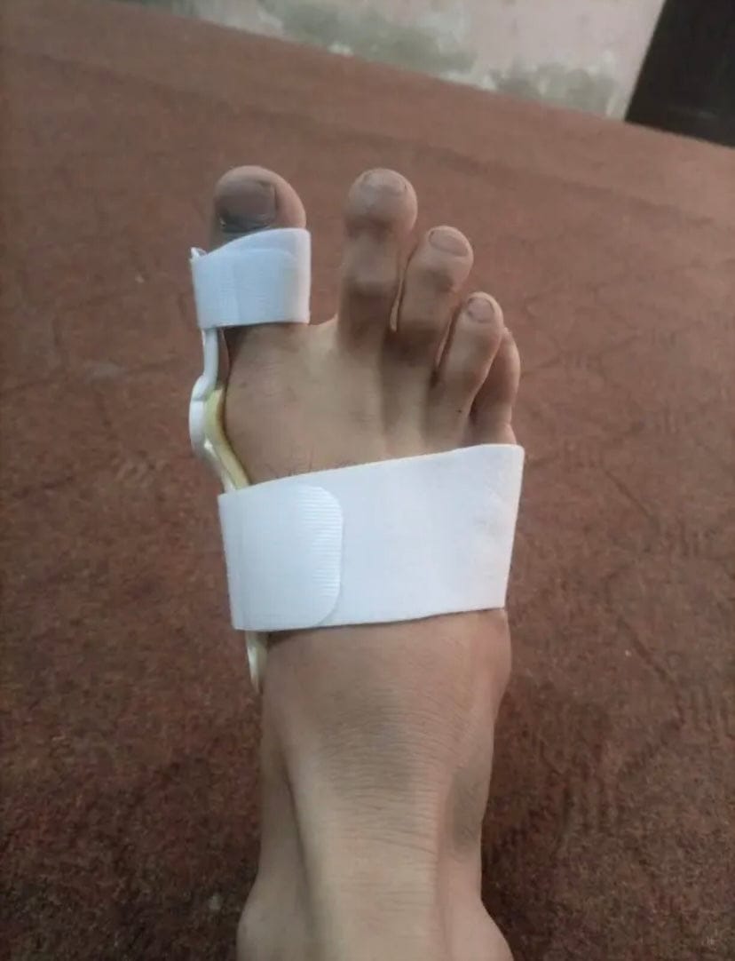Customer photo review of Pain Relief Bunion Toe Corrector - (IMPORTED)
