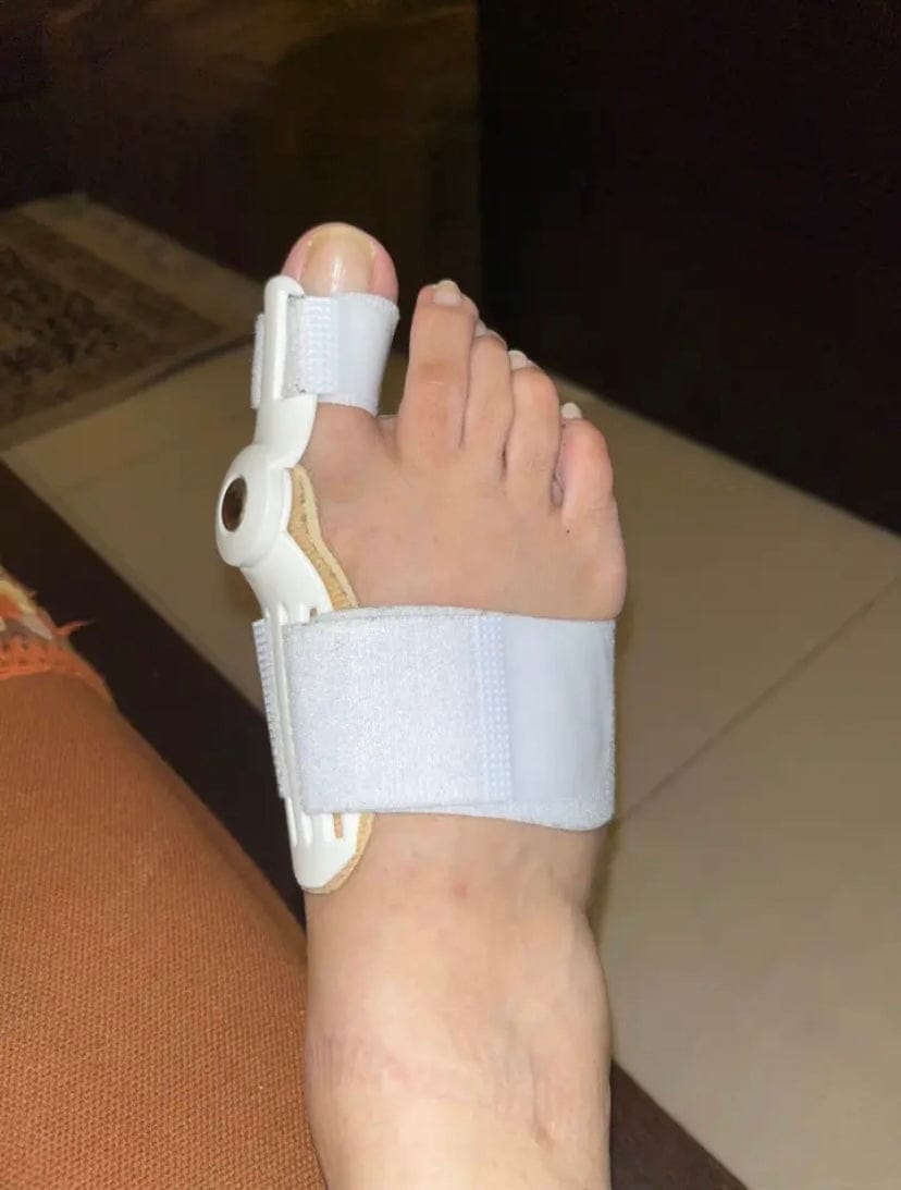 Customer photo review of Pain Relief Bunion Toe Corrector - (IMPORTED)