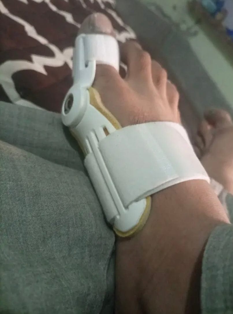 Customer photo review of Pain Relief Bunion Toe Corrector - (IMPORTED)