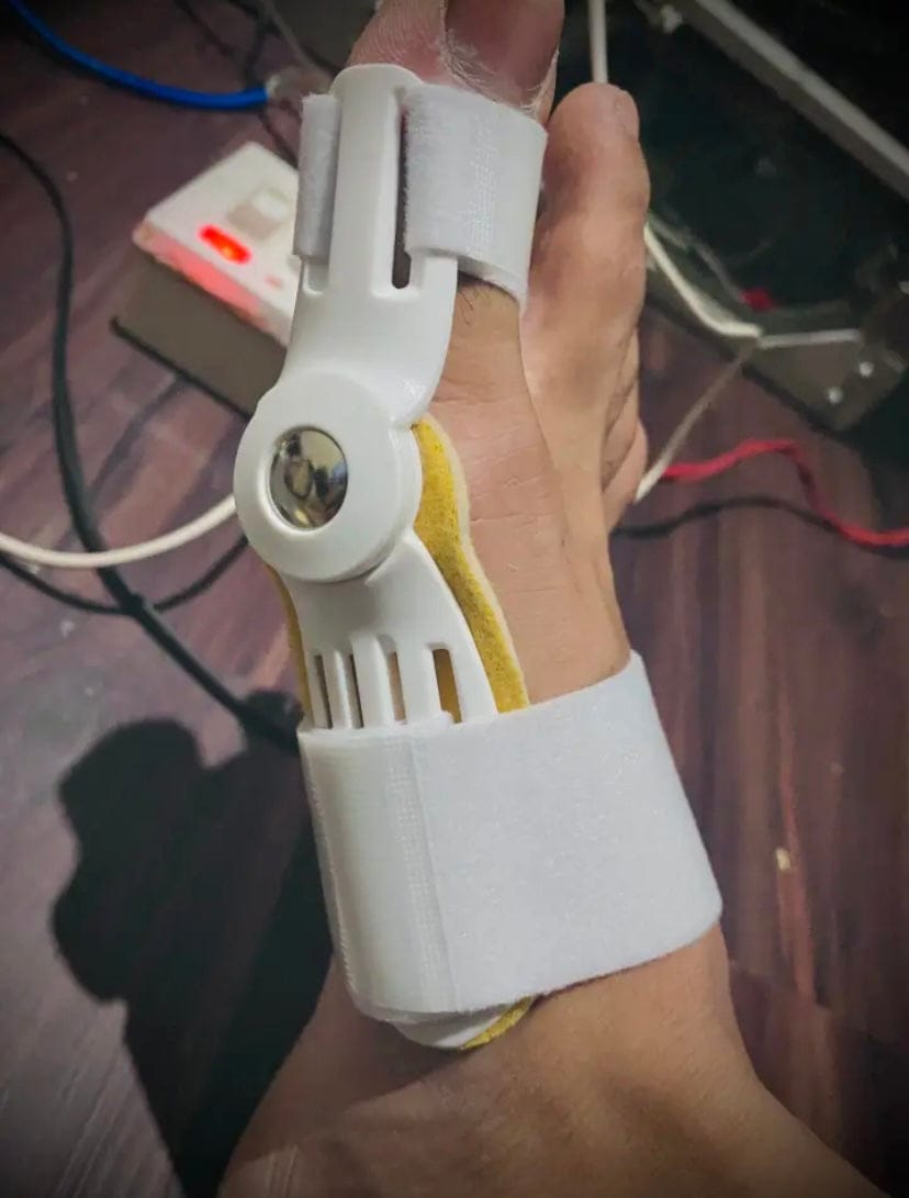 Customer photo review of Pain Relief Bunion Toe Corrector - (IMPORTED)