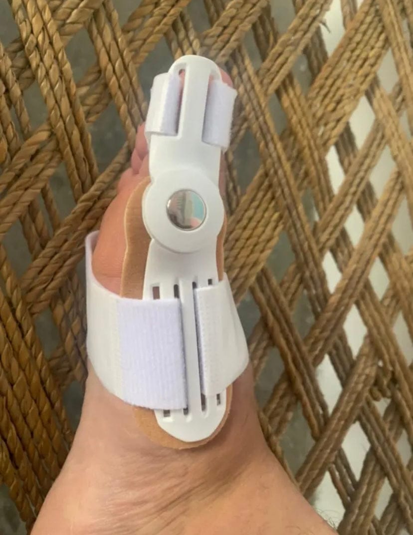 Customer photo review of Pain Relief Bunion Toe Corrector - (IMPORTED)