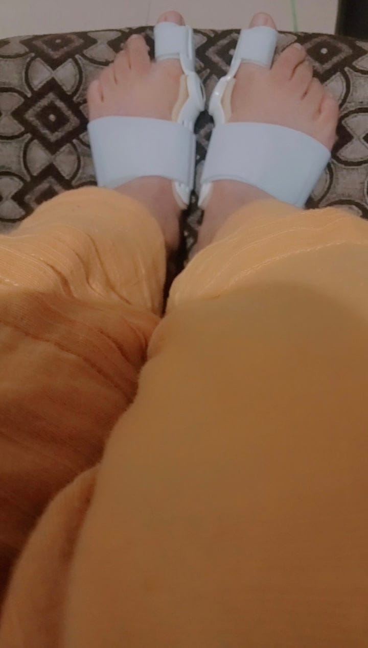 Customer photo review of Pain Relief Bunion Toe Corrector - (IMPORTED)