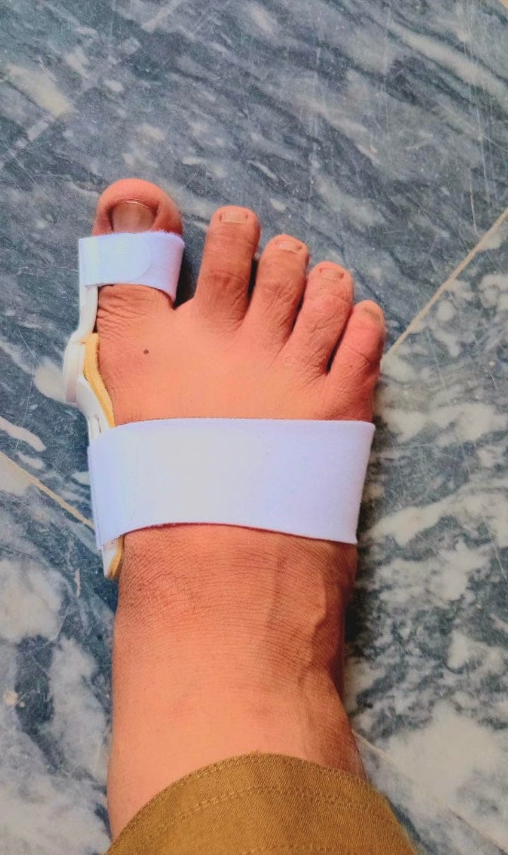 Customer photo review of Pain Relief Bunion Toe Corrector - (IMPORTED)