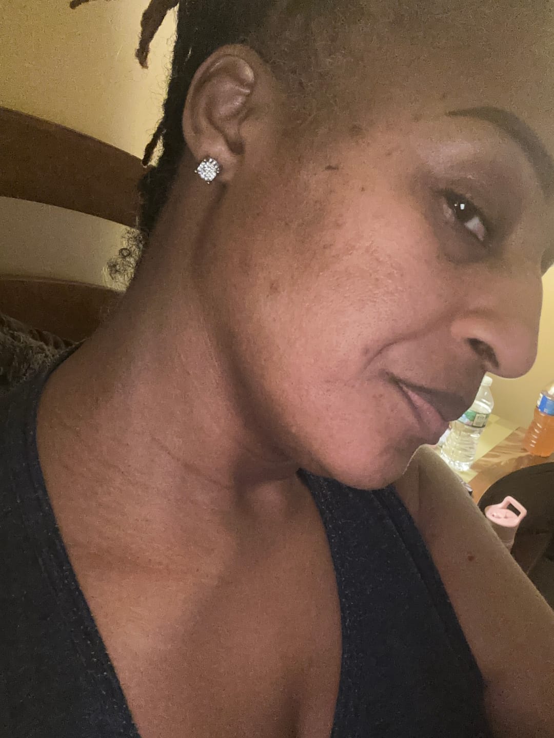 Customer photo review of Dark Spot Roller 50 ml (inner thighs and underarms)