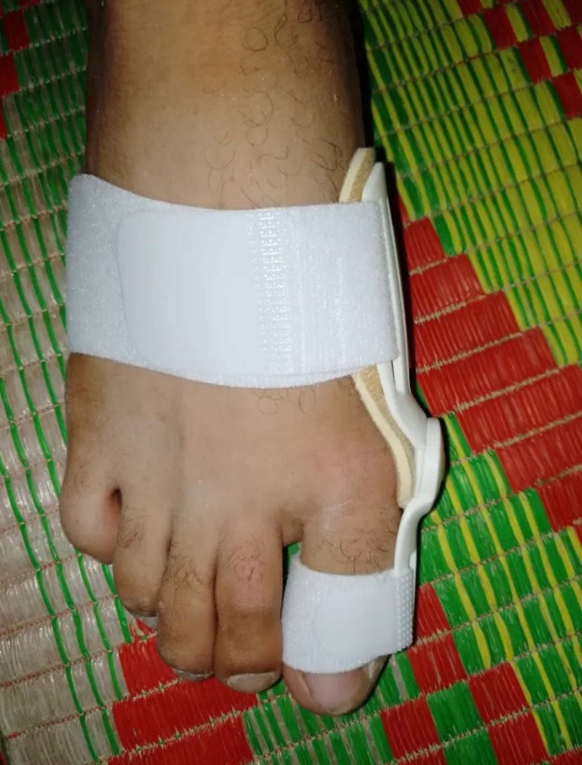 Customer photo review of Pain Relief Bunion Toe Corrector - (IMPORTED)