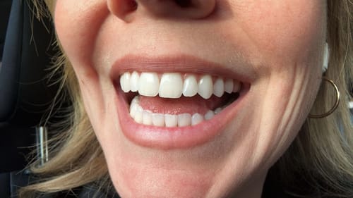 Customer photo review of bedrō Whitening