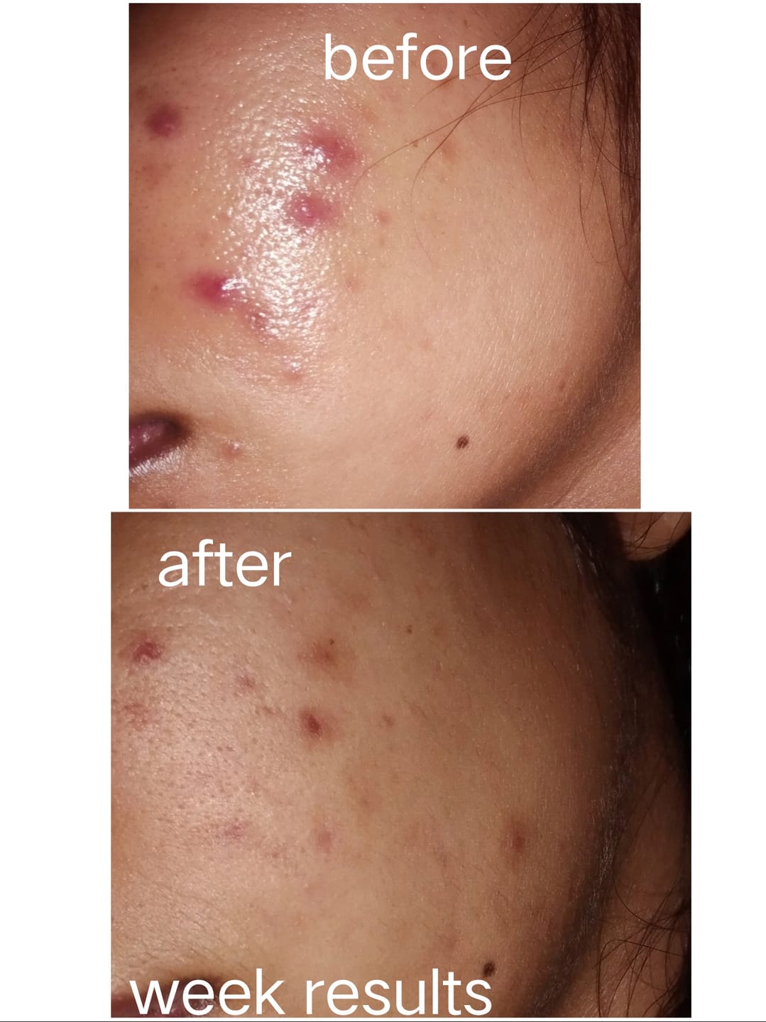 Customer photo review of Anti Acne Neem Face Wash