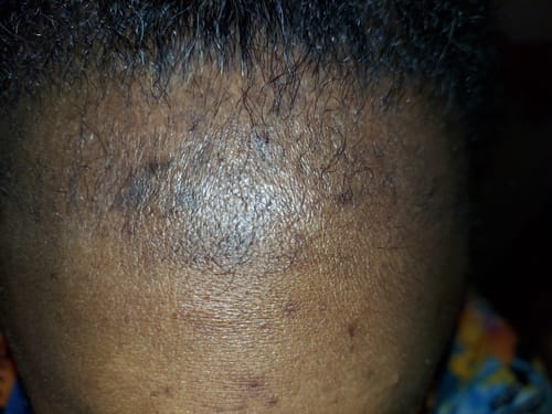 Customer photo review of VIRAL "EXTREME STRENGTH" Hair Growth Serum -