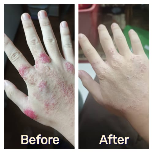 Customer photo review of Eczema Scratch Mitten