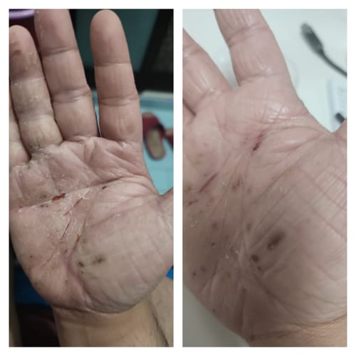 Customer photo review of Eczema Scratch Mitten