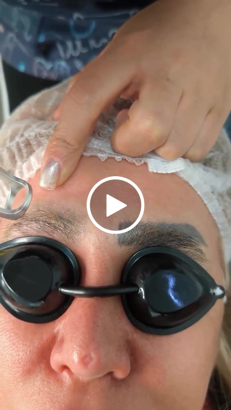 Customer video review of Laser Tattoo Removal Machine Q-switched ND YAG