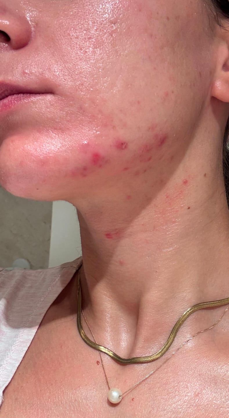 Customer photo review of A CONTROL - ACNÉ HORMONAL & RESISTENCIA A LA INSULINA