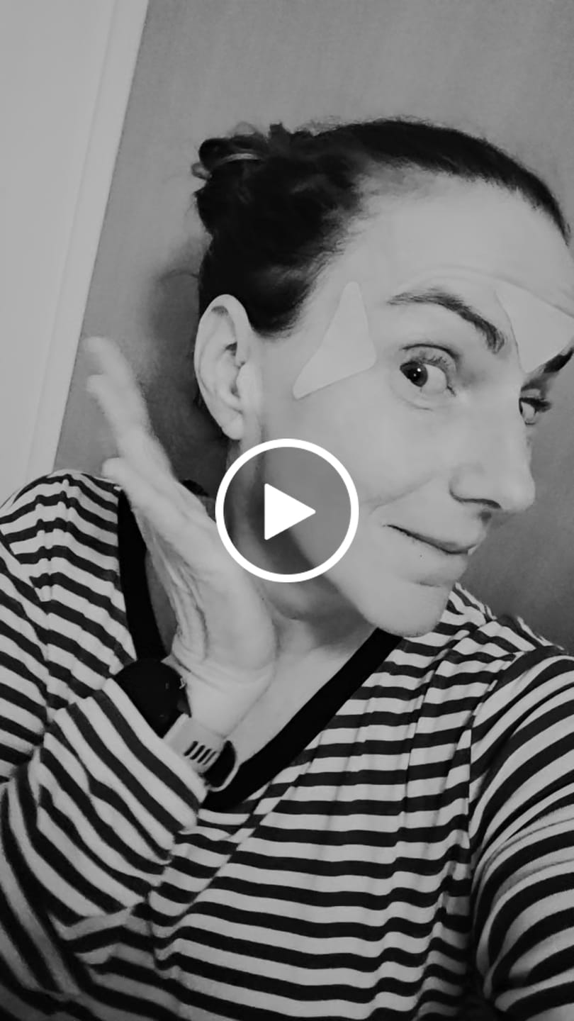 Customer video review of Zornesfalten Patches mit Hyaluron