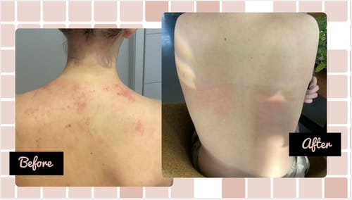 Customer photo review of Eczema Scratch Mitten