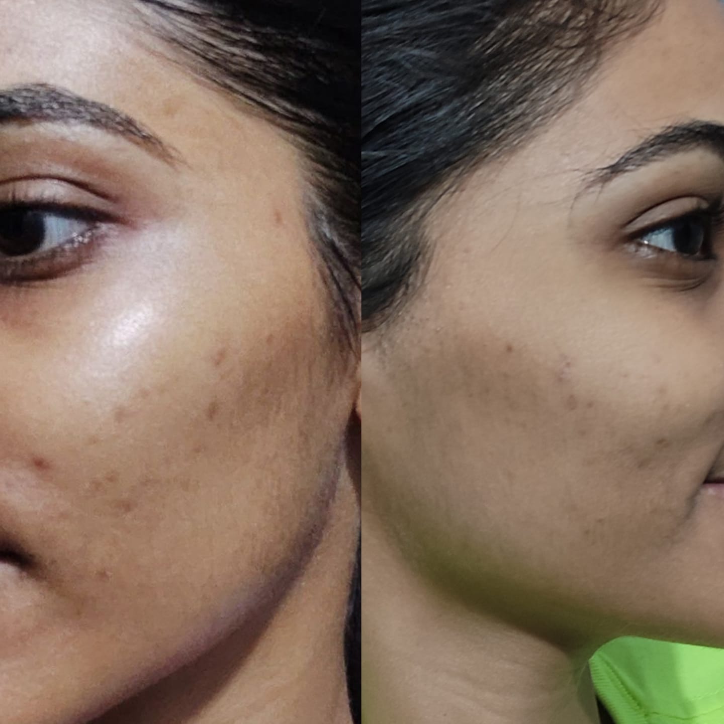 Customer photo review of ACNE CLARIFYING SERUM - Energetic Skin Therapy for Acne & Scars