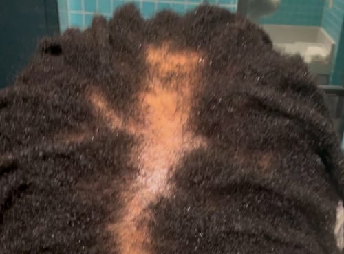 Customer photo review of JUMBO Scalp Stimulator