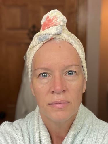 Customer photo review of The Microneedling Infusion System™