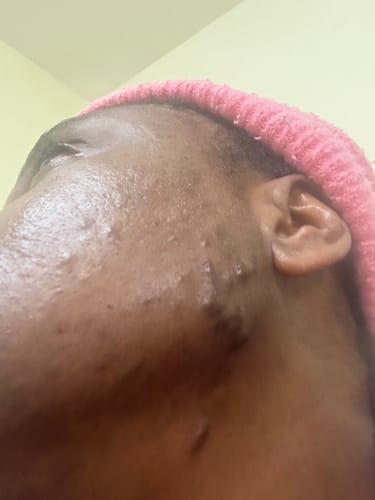 Customer photo review of Anti-Acne & Dark Spots African Soap