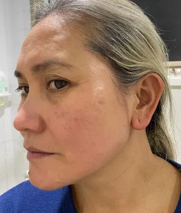 Customer photo review of The Microneedling Infusion System™