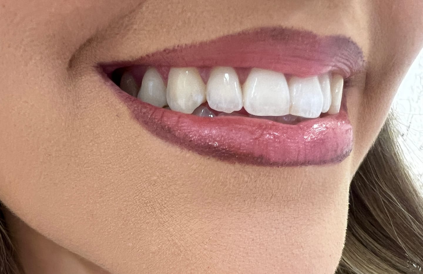 Customer photo review of Zahnbleaching-Set Rapid+ Dental Beauty - Teeth Whitening Kit