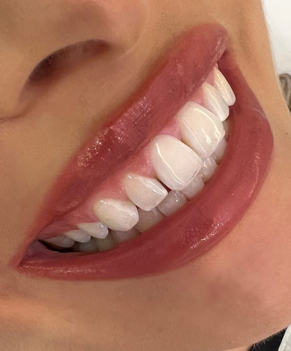 Customer photo review of Zahnbleaching-Set Rapid+ Dental Beauty - Teeth Whitening Kit