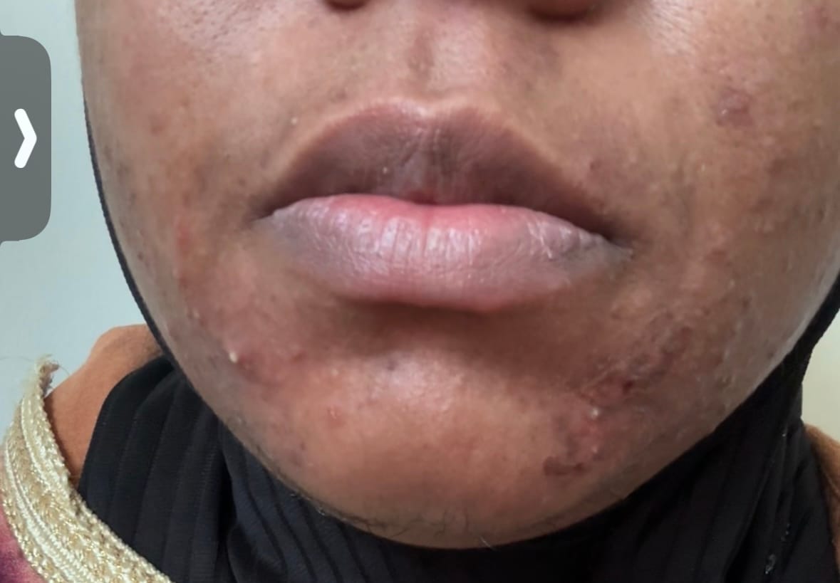 Customer photo review of 4 IN 1 MOUSSE NETTOYANTE ET ANTI ACNE