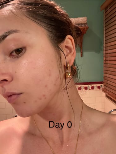 Customer photo review of Intermediate Acne Program™