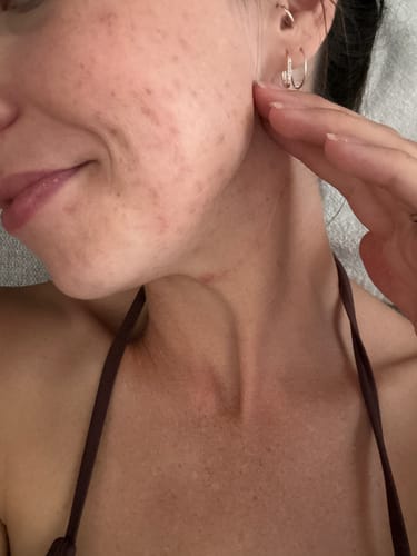 Customer photo review of PRE ORDER - Probiotic Moisturiser +