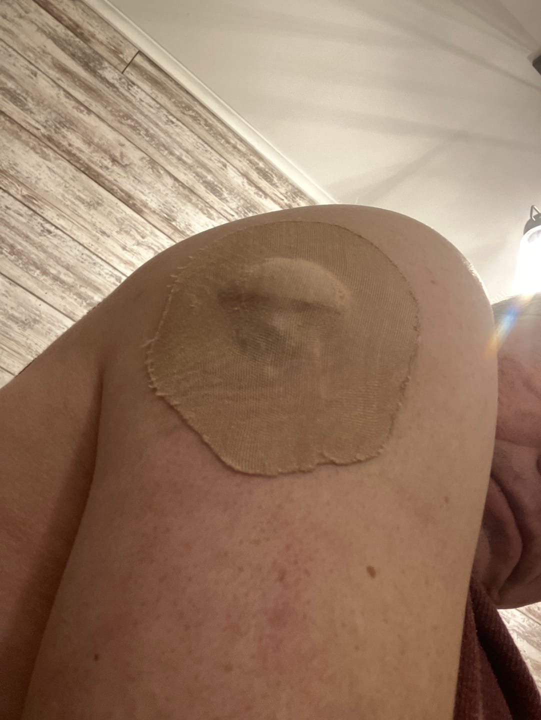 Customer photo review of Skin Grip Original - Medtronic Guardian/Enlite Adhesive Patches